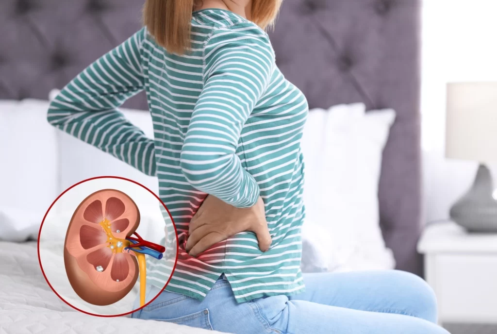 Kidney stone Treatment