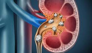 Kidney Stone Disease