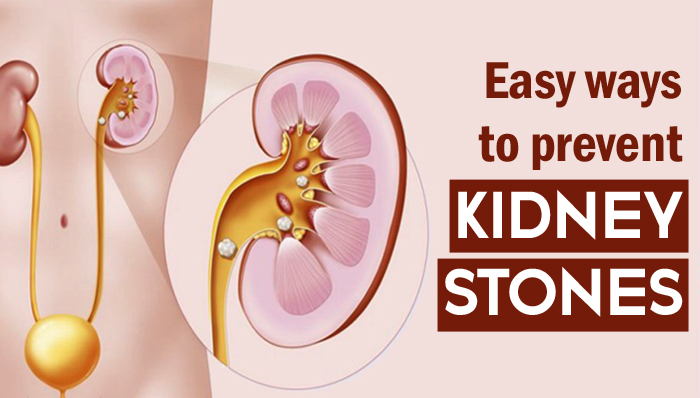 Kidney stone treatment at Agrawal Hospital, Jaipur