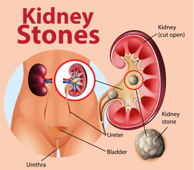 Kidney Stone Treatment