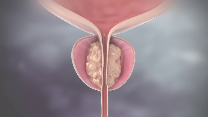 Prostate Treatment at Agrawal Hospitl, Jaipur