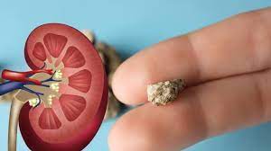 Best Kidney Stone Hospital in Jaipur